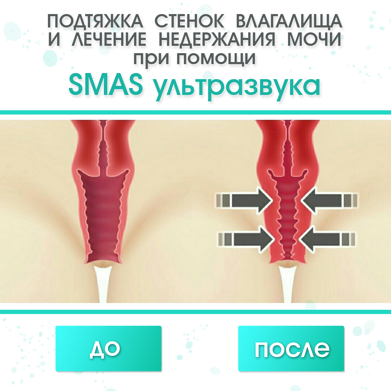 подтяжка влагалища при помощи Smas ультразвука подтяжка стенок влагалища и лечение недержания мочи при помощи Smas ультразвука
